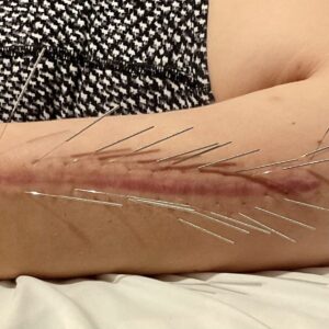 Acupuncture de cicatrices à Villeurbanne