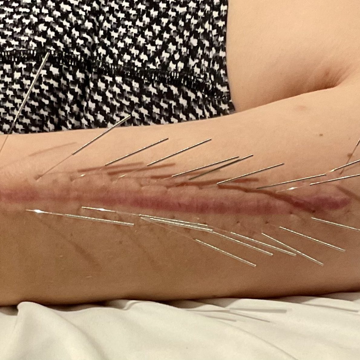 L&rsquo;acupuncture pour les cicatrices (césarienne, épisiotomie…)